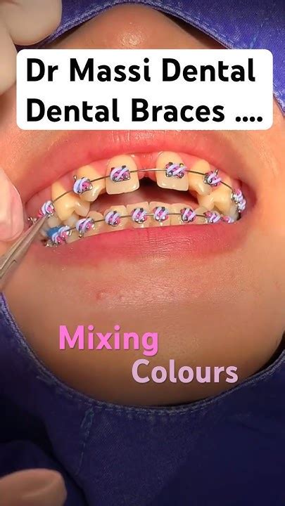 Mixing Colours Braces Orthodontics Youtube