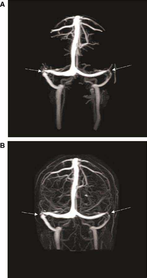 A Magnetic Resonance Venography Demonstrating Bilateral Transverse