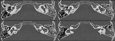 Hrct Of Temporal Bone The Cystic Cochlea And Vestibule Together Give A