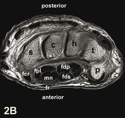 Wrist Hand Mri