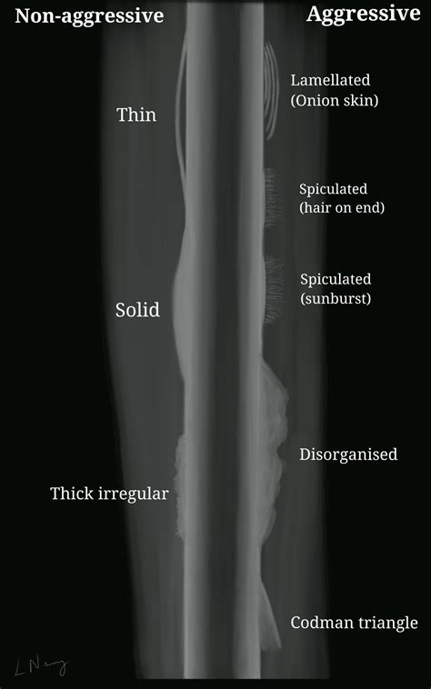 Bone Tumours | Ewing's sarcoma, Osteosarcoma | Geeky Medics