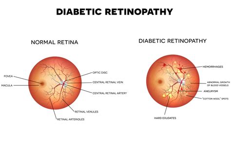 Retinopatia Diabética – Dr. Michel Rubin