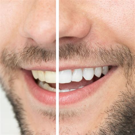 Professional teeth whitening your way - Samuel F. Jirik, DDS