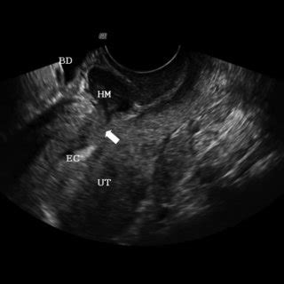 (PDF) Two-dimensional power Doppler-three-dimensional ultrasound ...