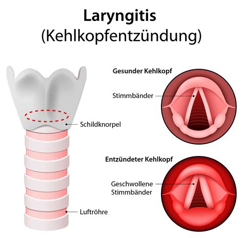 Laryngitis Kehlkopfentzündung Ursachen Behandlung