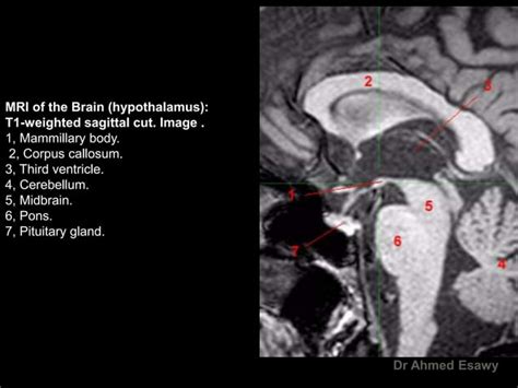 Mri Imaging Hypothalamus Dr Ahmed Esawy Ppt