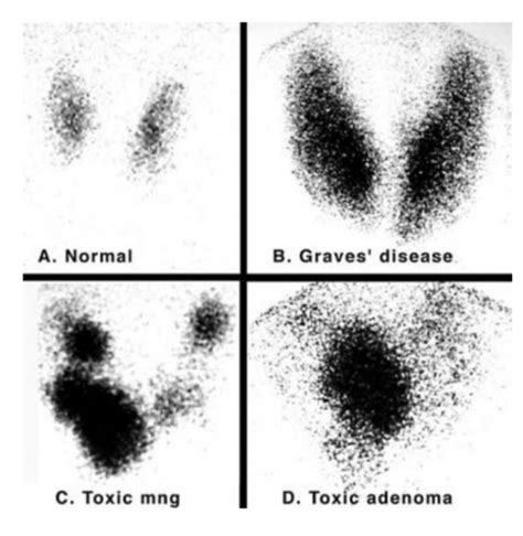 Thyroid Diseases Flashcards Quizlet