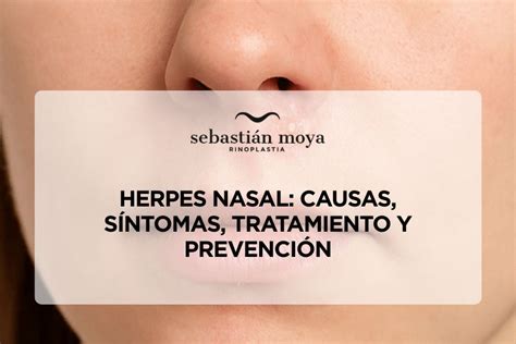 Herpes No Nariz E Perigoso - Herpes En La Nariz Infections Of The Nose And Paranasal Sinuses | Ento