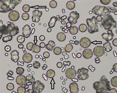 What are the types of Crystals found in Urine?