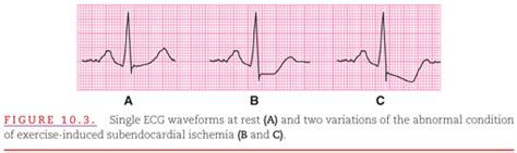 Subendocardial Infarction Ecg