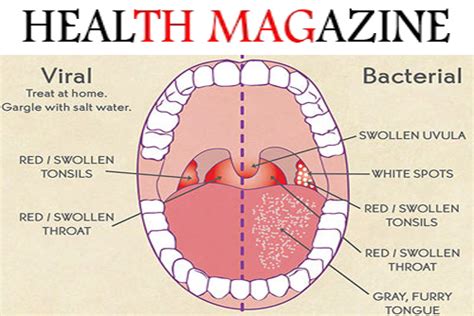 causes and how to treat a sore throat - HEALTH MAGAZINE