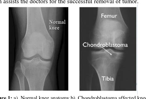 Figure 1 From Automatic Segmentation Of Chondroblastoma From X Ray