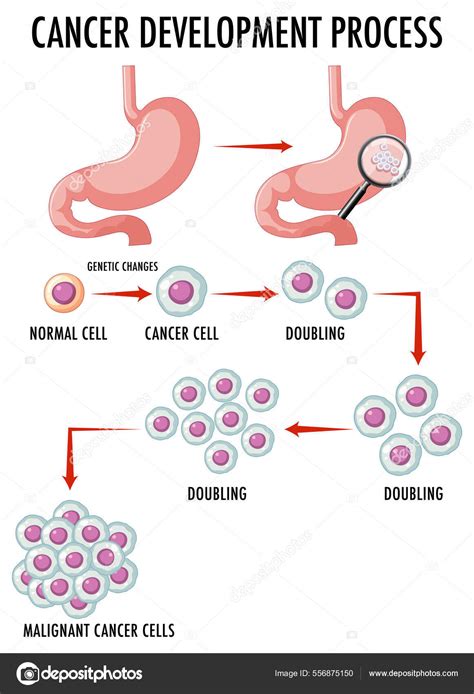 Diagram Showing Cancer Development Process Illustration Stock Vector By