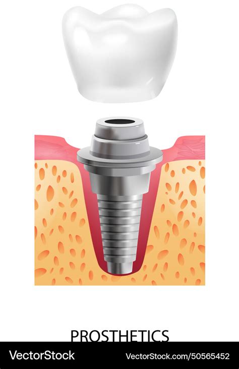 Dental Implantation Prosthetics Composition Vector Image