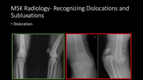 MSK Radiology Recognizing And Describing Abnormalities Flashcards