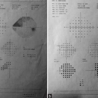 Visual Field A Od Wide Upper Nasal Step Md B Os