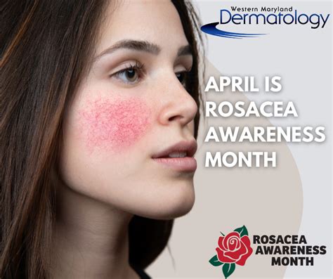 Understanding Rosacea Shedding Light During Rosacea Awareness Month