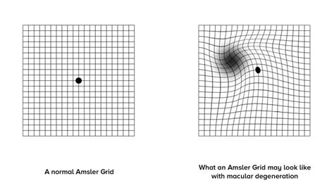 Macular Degeneration Eye Chart Grid