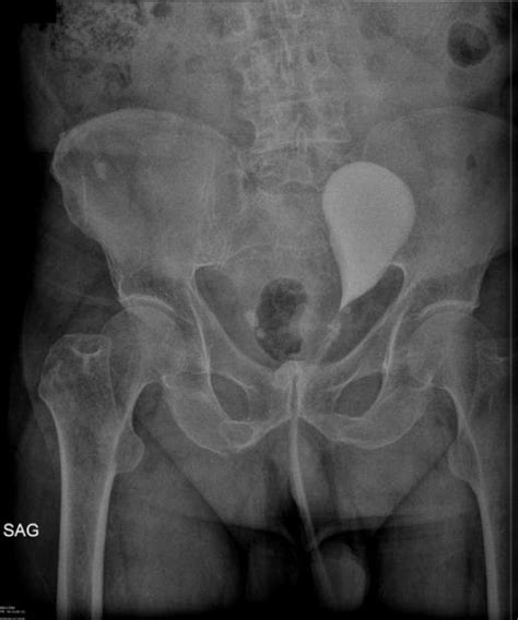 Image of the deviated bladder on cystogram | Download Scientific Diagram