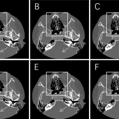 Axial Ct Soft Tissue Window Images From Different Reconstruction Download Scientific Diagram