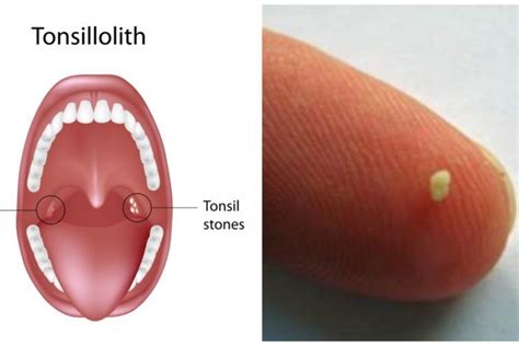 What Are Tonsil Stones And How Are They Treated Simplemost Gum Health