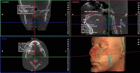 Evaluation Of The Pharyngeal Airway Space Before And After Bi Lateral