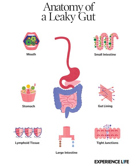 Anatomy of a Leaky Gut (Infographic) Read more about leaky gut syndrome