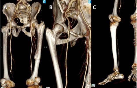 A Computed Tomography Angiography Of The Lower Limbs Showing