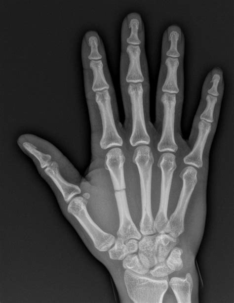 Dr. Sammy - Metacarpal Fracture