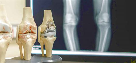 What is Knee Replacement Surgery? - Aakash Healthcare