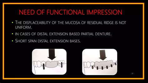 Impression Techniques In Rpd Ppt