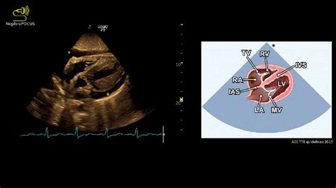 Pericardial Effusion In A Dialysis Patient Things To Observe On Focused Cardiac Ultrasound