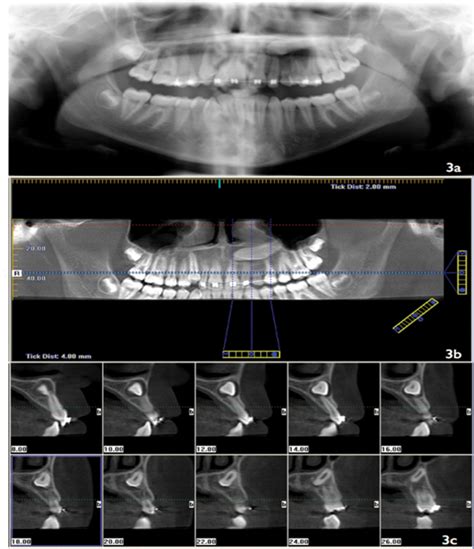 Usefulness Of Cone Beam Computed Tomography For The Diagnosis And