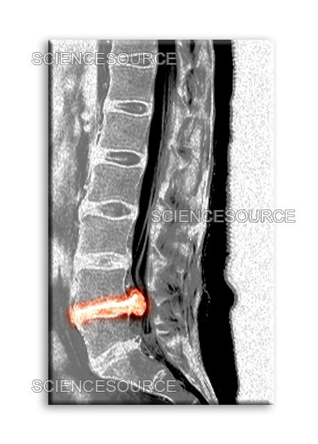 Large Herniated Lumbar Disc Mri Stock Image Science Source Images