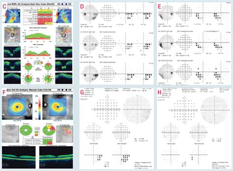 10-2 Visual Field Testing: A Tool for All Glaucoma Stages