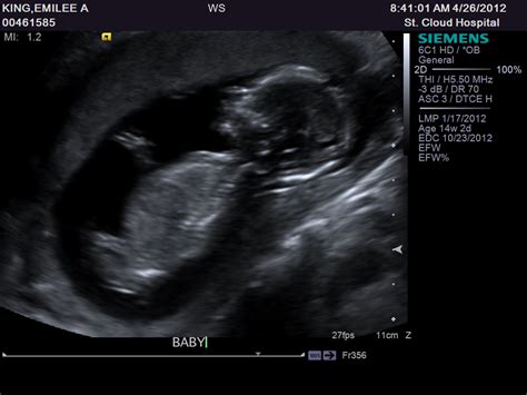 Lillie Mae 14 Week Ultrasound Pictures