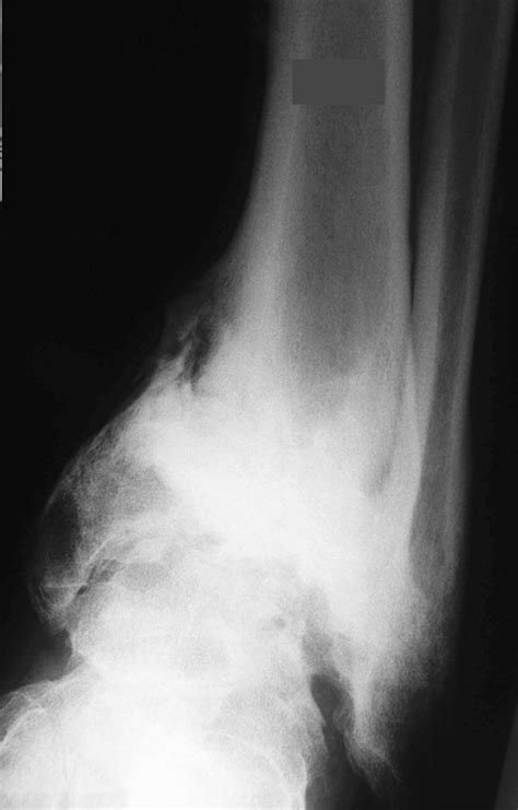 Anatomy Of Pilon Fractures Of The Distal Tibia Bone And Joint