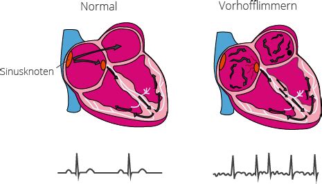 Vorhofflimmern Ein Verbreitetes Herzproblem Cardiosecur