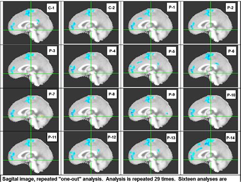 Figure 1 From Reliability Analysis Of The Resting State Can Sensitively