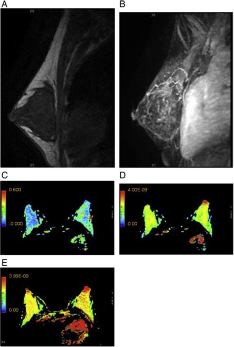 Diffusion Tensor Imaging In The Normal Breast Influences Of