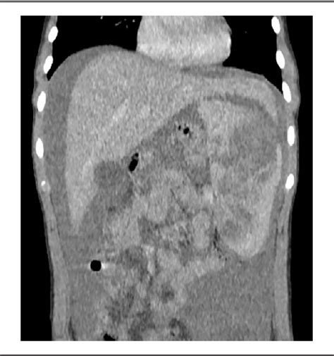 Figure From Gray Platelet Syndromeunusual Presentation With