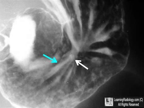 Gastric Ulcer Radiology Imaging Radiology Ulcers