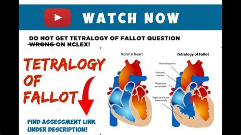 TETRALOGY OF FALLOT Causes Pathophysiology Diagnosis Surgical