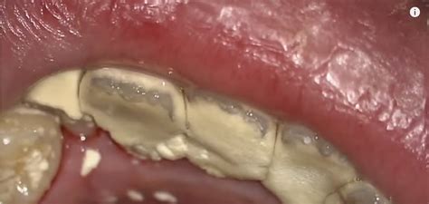 How To Remove Tartar And Dental Plaque From Teeth Naturally Smile Widely