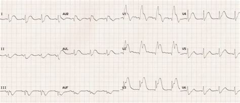 Anterior Myocardial Infarction • Litfl • Ecg Library Diagnosis