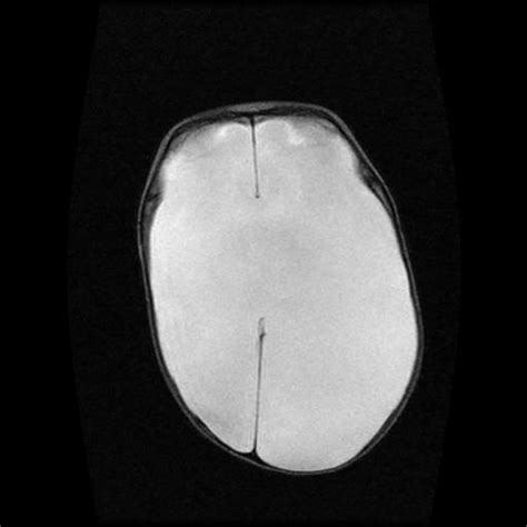 Hydranencephaly Image