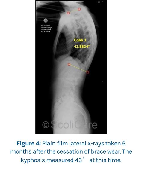 Case 16 Year Old Male Adolescent Patient ScoliBrace