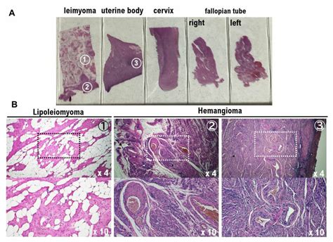 Identification of lipoleiomyoma and hemangioma locations by ...