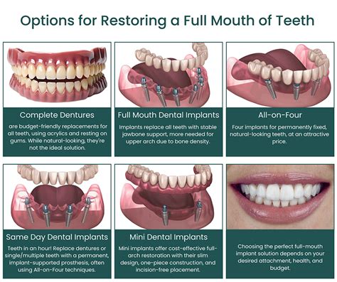 Missing Full Mouth Teeth Replacement Options | Riverside Oral Surgery