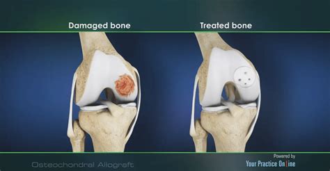 Osteochondral Allograft - Michigan Knee Institute